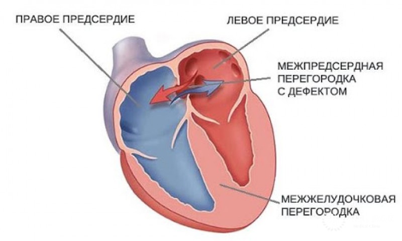 Дефекты межпредсердной перегородки