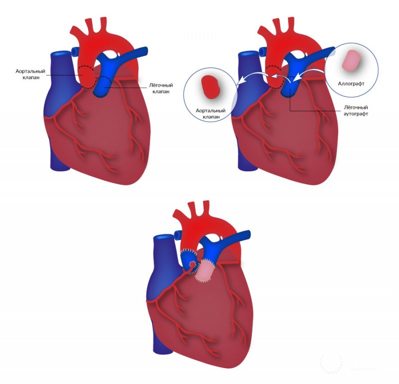 Процедура Росса