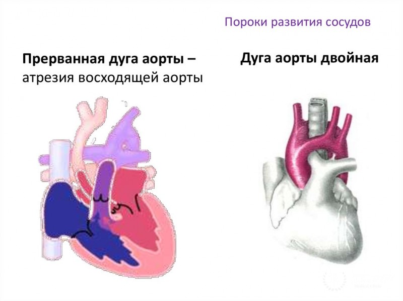 Пороки развития дуги аорты