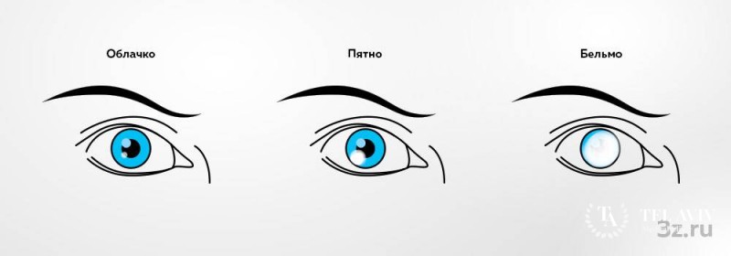 Помутнение роговицы у детей