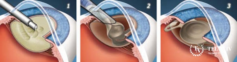 Имплантация хрусталика у детей
