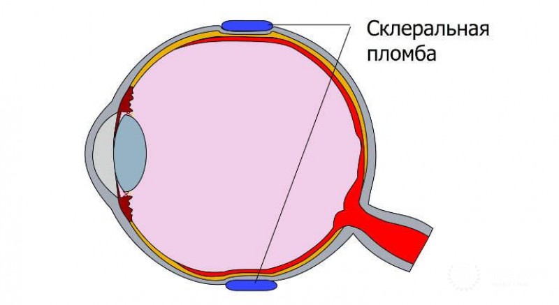Эписклеральное пломбирование глаз у детей