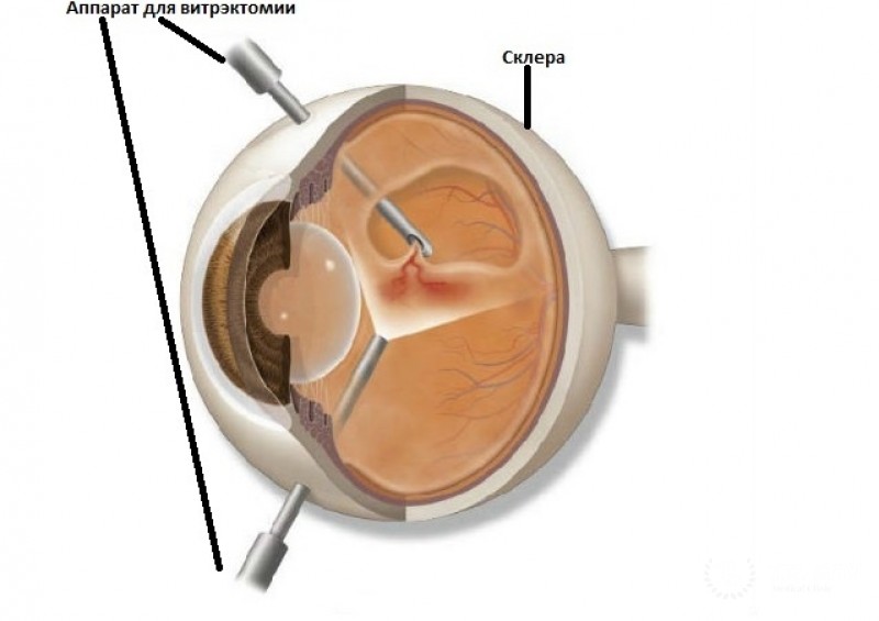 Витрэктомия глаз у детей