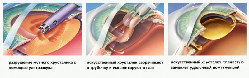 Удаление катаракты с имплантацией интраокулярной линзы
