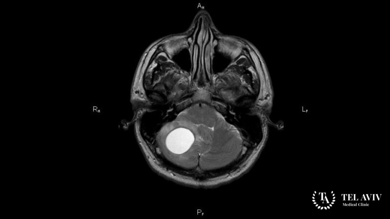 Гемангиобластома головного мозга