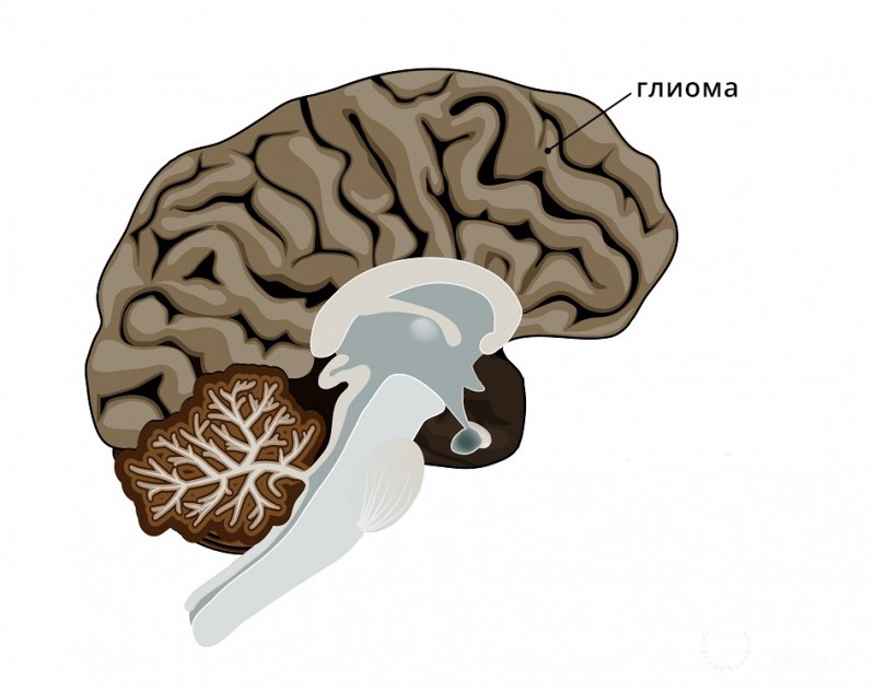 Глиома - симптоматика, лечение
