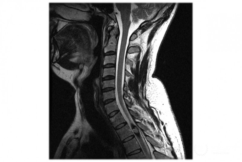 Кавернома сосудов головного мозга