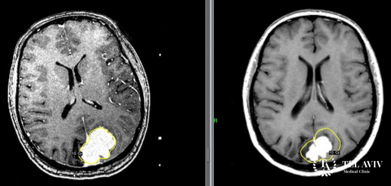 Менингиома - симптоматика и лечение