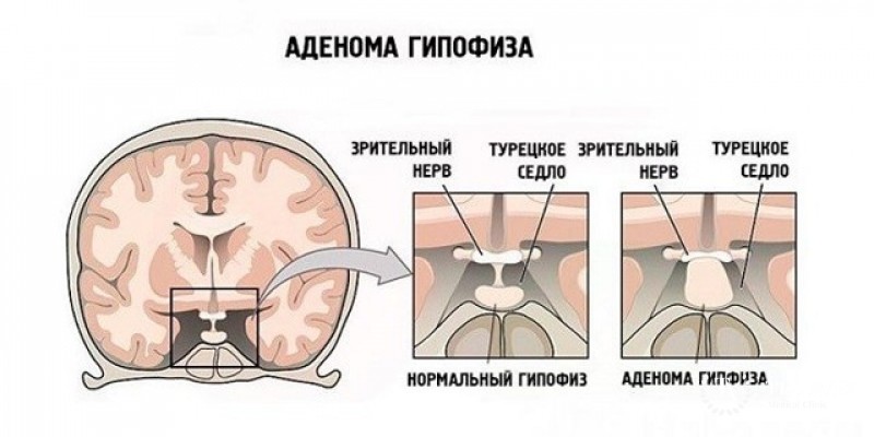 Базофильная аденома гипофиза