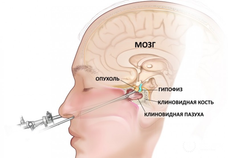 Смешанная ацидобазофильная аденома гипофиза
