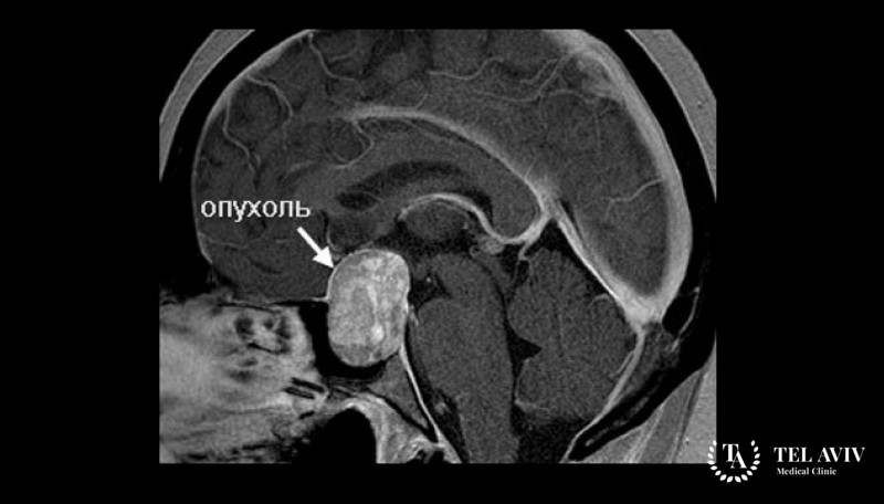 Аденокарцинома гипофиза