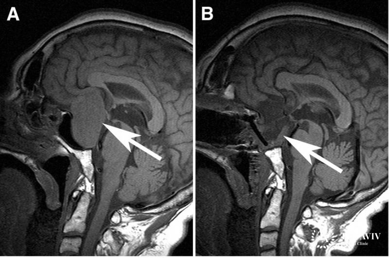 Гонадотропинома