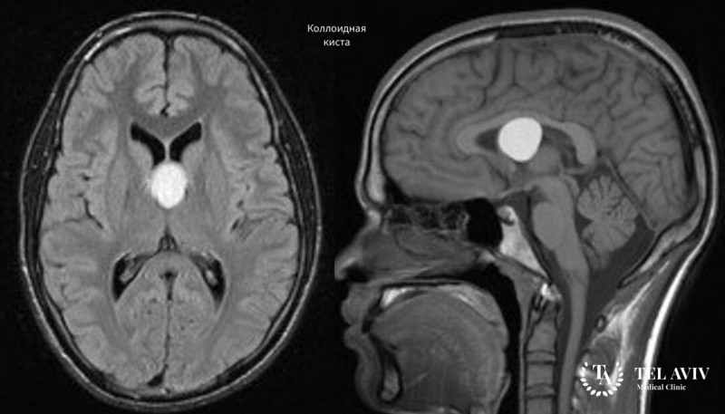 Коллоидная киста