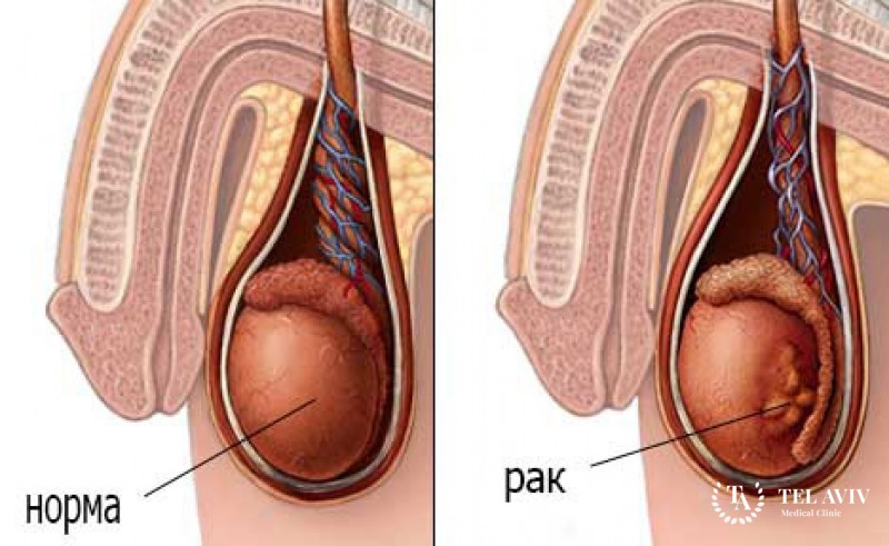 Семиномы у детей