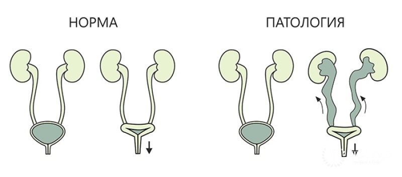 Рефлюкс у детей