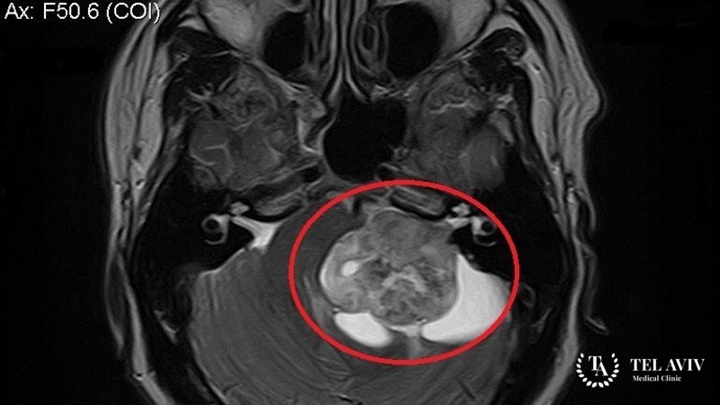 Невринома периферического нерва