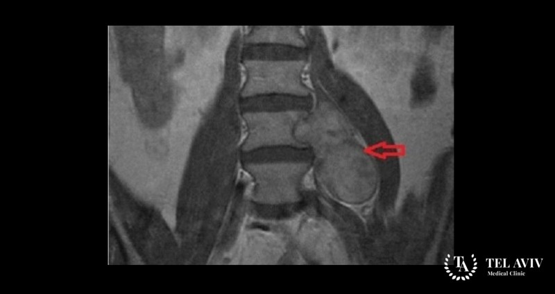 Невриномы спинного мозга и позвоночника