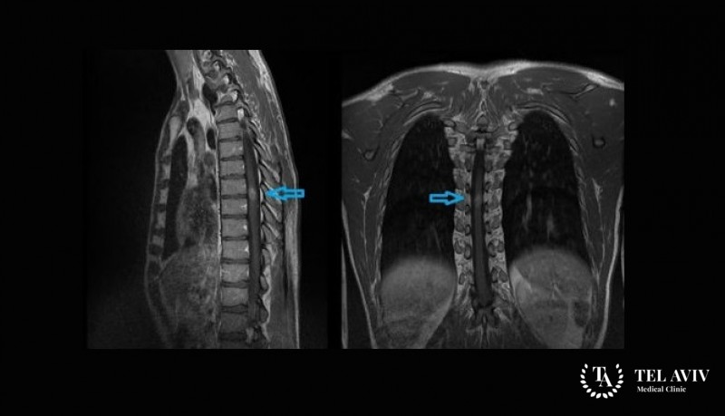 Эпендимомы спинного мозга