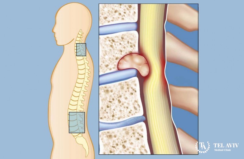 Кисты спинного мозга и позвоночника