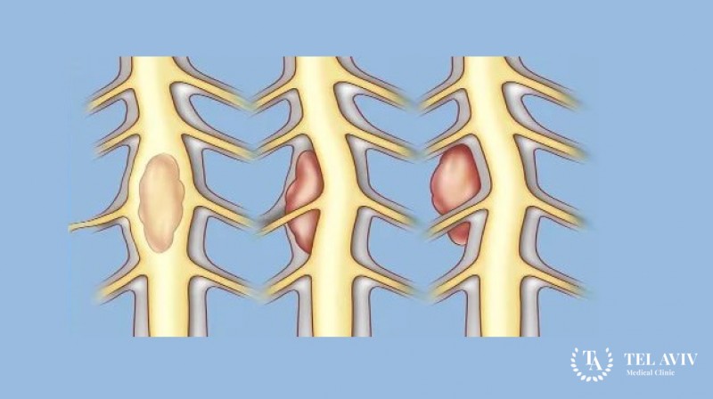 Олигодендроглиома спинного мозга и позвоночника