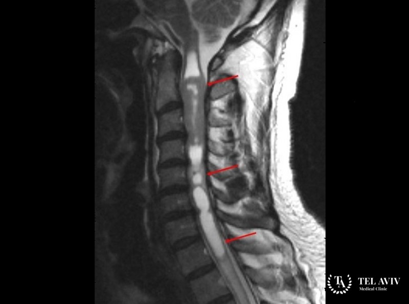 Шваннома спинного мозга и позвоночника
