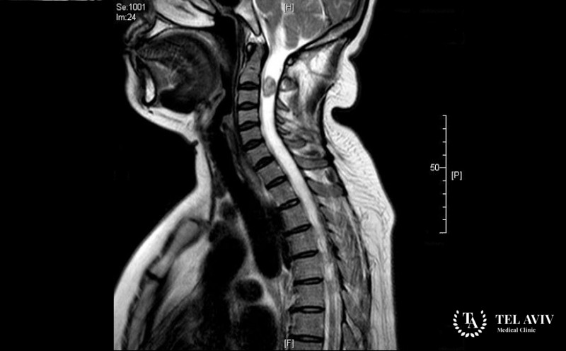 Неврилеммома спинного мозга и позвоночника