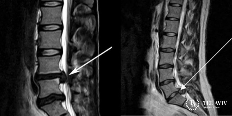 Нейринома - информация про заболевание
