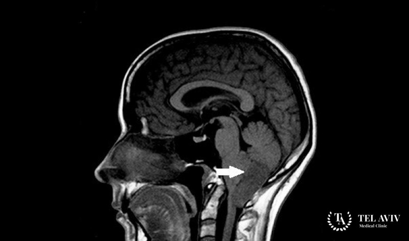 Субэпендимома - вся информация
