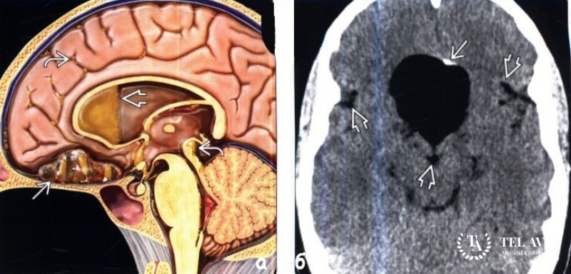 Дермоидная киста - полная информация