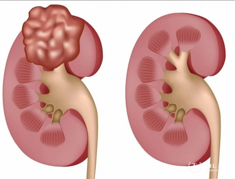 Опухоли почек у детей