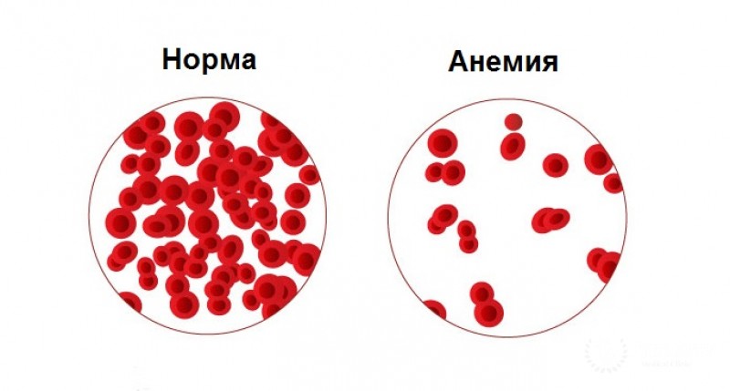 Анемия - полная информация