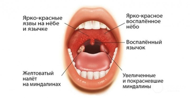 Инфекционный мононуклеоз