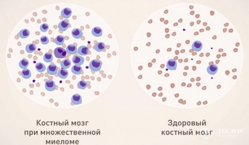 Множественная миелома