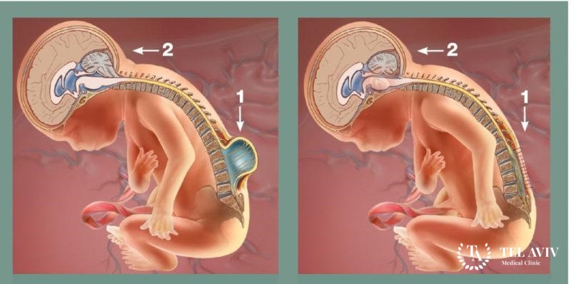 Миелодисплазия