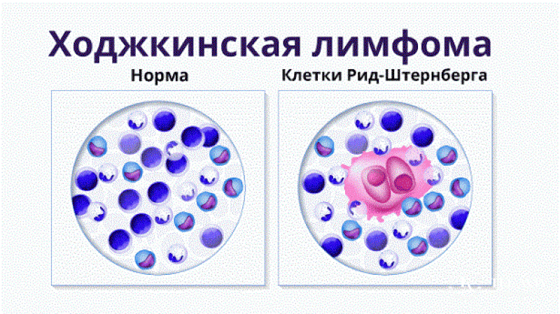 Ходжкинская лимфома (лимфогранулематоз)