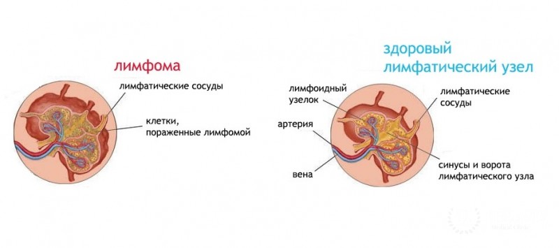 Анапластическая крупноклеточная лимфома