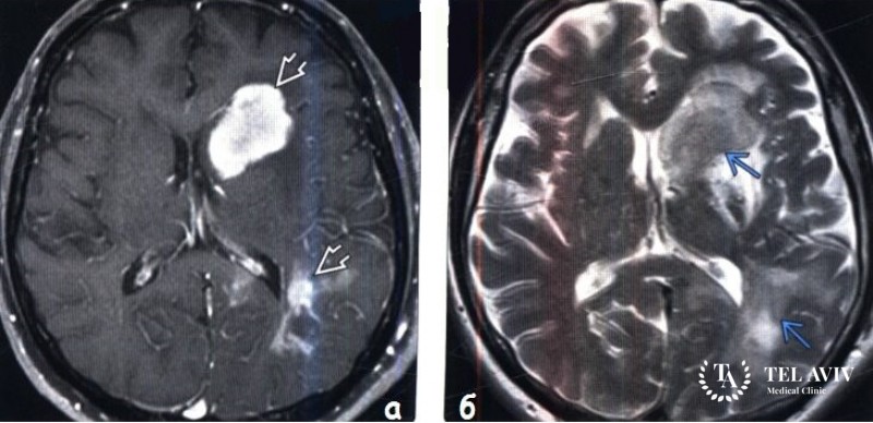 Первичная лимфома центральной нервной системы