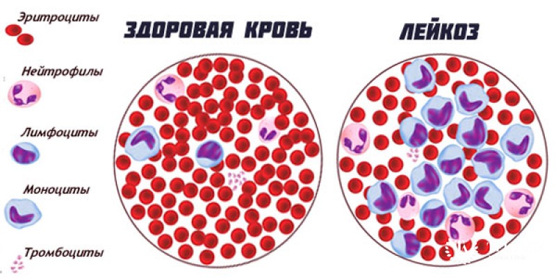 Хронические лимфобластные лейкозы (ХЛЛ)