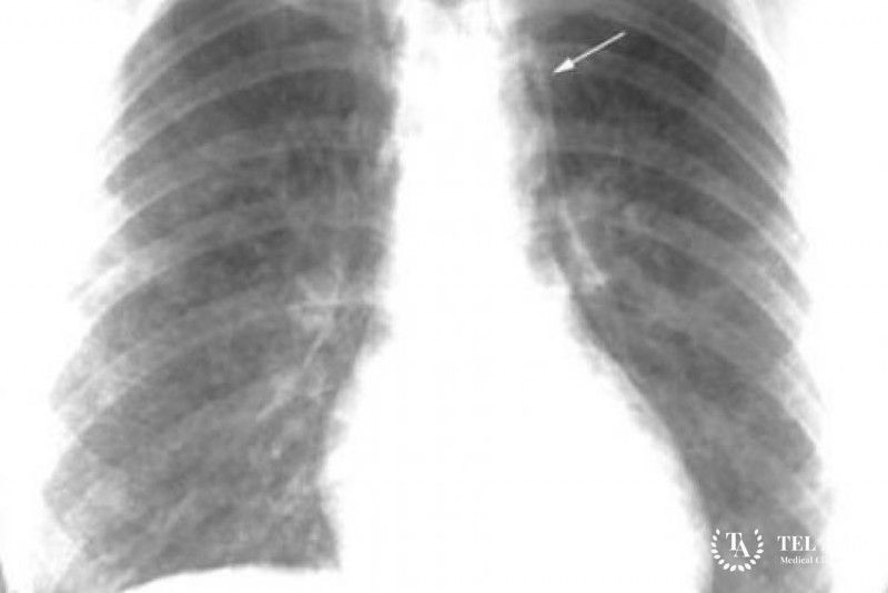 Гистоцитоз Х