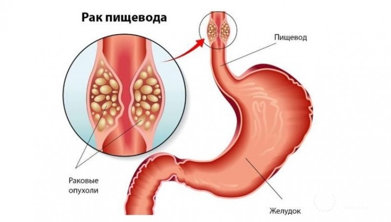 Диагностика и лечение раковых заболеваний пищевода