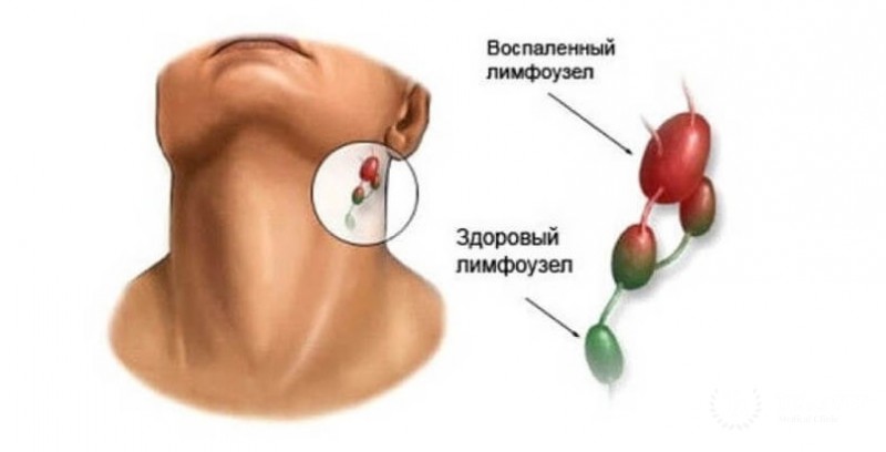 Новообразования в лимфоузлах шеи