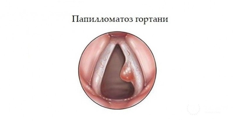 Папилломатоз гортани