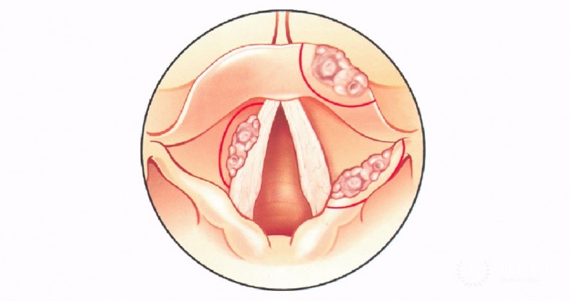 Рак голосовых связок