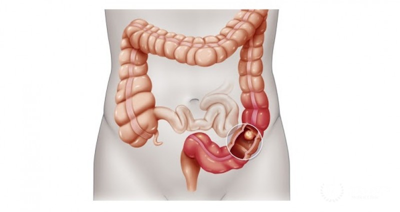 Что такое колоректальный рак?