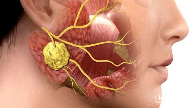 Рак слюнной железы