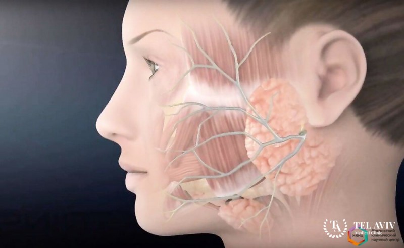 Карцинома из смешанной опухоли – аденокарцинома