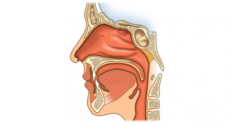 Менингиома носа и околоносовых пазух