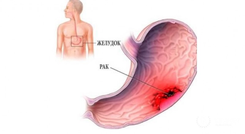 Раковые патологии желудка