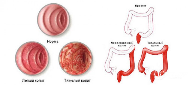 Язвенный колит – определение заболевания, лечение