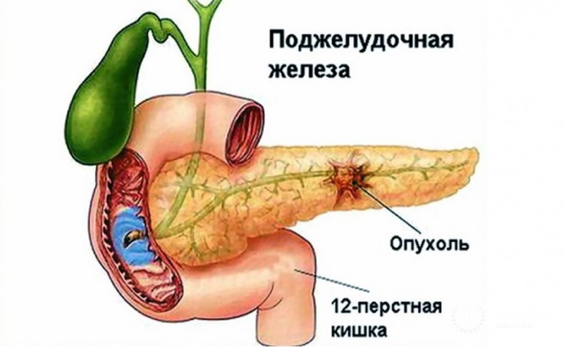 Опухоли поджелудочной железы